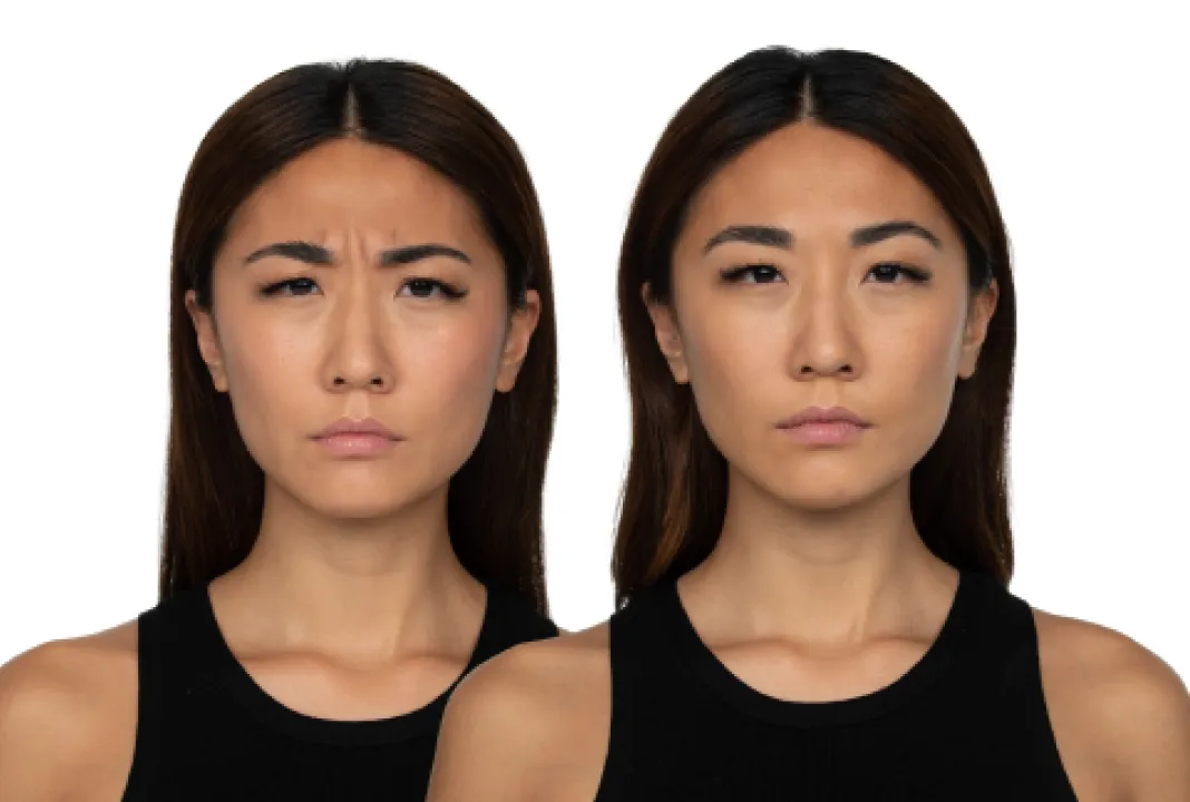 Between the brows before and after Botox treatment