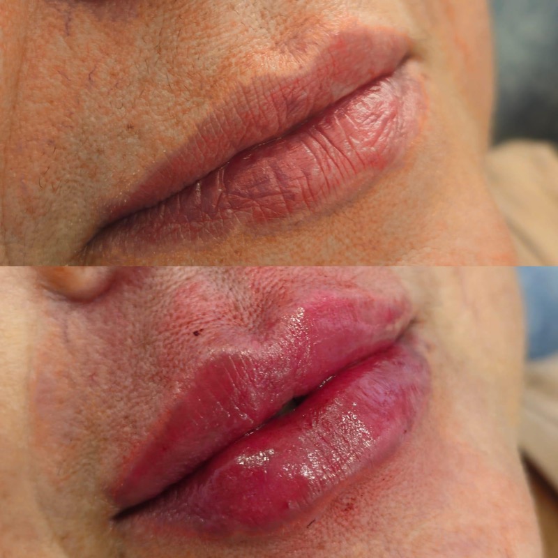 Lip filler before and after — volume enhancement at Chan Ramos MedSpa